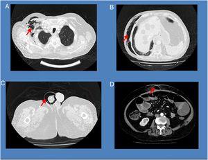 Images A, B and C show the patient’s subcutaneous emphysema extending from the underarm (A) to the right testicle (C). Image D shows the eviscerated loop causing the perforation from which the patient’s emphysema originated.