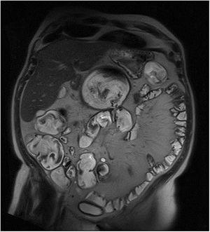 Coronal MRI.