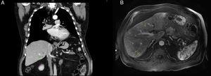 A) The CT shows a hypodense lesion in the right lobe of the liver. B) Bilobar hyperintense lesions in T1 on the MRI.