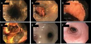 Endoscopic findings. (A) Mucosa of the medial oesophagus with blackish discolouration and longitudinal ulcerations. (B and C) Abrupt stop at the gastro-oesophageal junction. (D) Necrosis of the second duodenal segment. (E) Obstructive oesophageal stenosis shown on follow-up gastroscopy. (F) Course of oesophageal stenosis following several sessions of dilatation.
