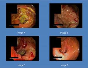 Image A shows the pseudotumour in the first colonoscopy. Images B and C show the lesion in the second colonoscopy. Image D shows mucosal healing after antiviral treatment.