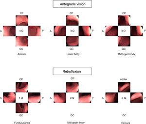 Photographic mapping according to the systematic screening protocol for the stomach (SSS) for the surveillance of gastric cancer precursor lesions.