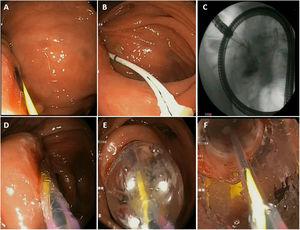 Practical considerations in endoscopic balloon dilation. A) Passage of the guide through the stricture. B and C) Insertion of a Fogarty balloon and injection of contrast. D and E) Insertion and progressive inflation of the pneumatic balloon. F) Visualisation of stricture dilation through the pneumatic balloon.