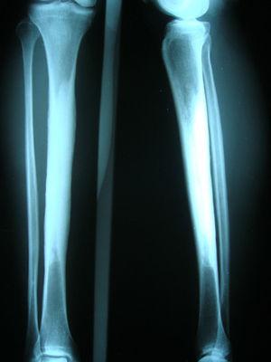 AP and lateral X-ray of the tibia and fibula showing a large sclerotic phenomenon in the diaphyses of both bones in a symmetrical manner.