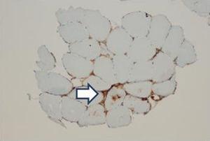 Immunohistochemical study for HLA-1 with expression of muscle fibers (arrow).