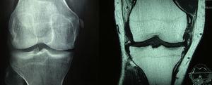 sur le côté gauche sur la radiographie AP des genoux est calcification observée de la médiane Ligament collatéral dans sa partie proximale, en plus d'une diminution de l'espace fémorotique médial. Au bon côté de l'acquisition coronale avec T1, les informations du genou deviennent évidentes une ossification à la fin proximale du ligament collatéral médial, en relation avec une blessure ancienne, configurant une lésion Pellegrini-STIEDA. Les changements ostéoarthritiques avec la formation d'ostéophytes marginaux dans le compartiment médial sont également observés.