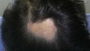 Circumscribed morphea on the scalp. Secondary alopecia.
