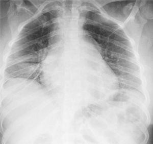Mediastinal widening in chest X ray.