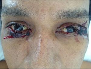 Patient med ikke-eksudativ bilateral conjunctivitis.