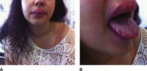 Abnormal findings on physical examination. A – Macrocheilitis; B – Lingua plicata or scrotal tongue.