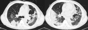 Thorax CT 10 days after admission and before glucocorticoid therapy beginning.