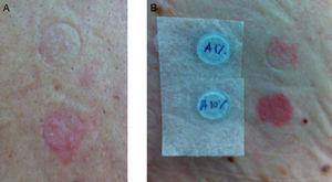Abacavir patch tests (1% on top, 10% on bottom), readings at 48h, from cases 4 (A) and 5 (B).
