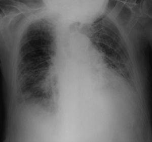Chest radiography on admission – bilateral interstitial/alveolar infiltrates.