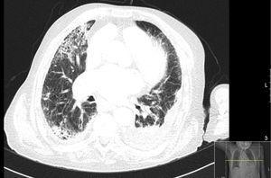 Chest CT on the 9th day of hospitalization – left pleural effusion, consolidation/atelectasis of the lung adjacent to the pleural effusion and bilateral ground glass opacities.