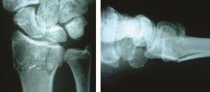 Radiografía anteroposterior y lateral: fractura metafisaria de radio distal, desplazada a dorso y compromiso articular de fosa del semilunar (caso 1-a).