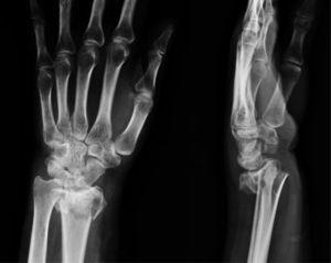 Radiografía anteroposterior y lateral: fractura con conminución metafisaria de radio distal, marcado desplazamiento dorsal y compromiso articular (caso 2-a).