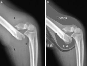 A) Se observan, en radiografías laterales del codo, las diferentes densidades de los músculos tríceps braquial (1), braquial anterior (2) y bíceps braquial (3). B) remarcado.