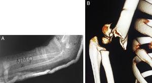 A) Radiografía lateral estricta, en la que se aprecia la lateralidad del fragmento distal y la rotación interna del fragmento proximal, comprobado con TC-3D (B).