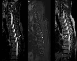 Remisión de la columna dorsal con secuencias sagitales STIR (a), T2FS de Dixon (b) y T2 (c). Se observa edema de médula ósea en la apófisis espinosa de D5 (flecha en a) y en los pedículos de D5 y D6 (flechas en b), sin definir líneas de fractura. Se muestra una protrusión central del disco D5-D6 (flecha en c).