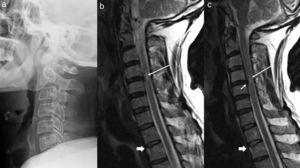 Radiografía lateral de la columna cervical (a) y RMN de la columna cervical con secuencias sagitales ponderadas en T1 (b) y T2 (c). En la radiografía lateral sólo se observa un enderezamiento de la lordosis. Las imágenes de RM muestran una irregularidad y alteración de la señal del disco superior D2, consistente con una fractura por compresión (flechas gruesas en b y c). Se observa una pequeña protuberancia central a nivel de C4-C5 (flecha en c), que asocia una ligera reducción del canal y una zona de edema medular (flechas largas en b y c).