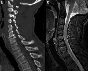 Reconstrucción sagital de TC cervical (a) y secuencia STIR de RM (b) en planos sagitales. El paciente presentó una tetraparesia inicial de la que se recuperó en pocas horas. La imagen muestra un osteofito posterior C6-C7 (a), así como una imagen de hipertrofia del ligamento longitudinal posterior al mismo nivel. Este estado previo podría haber causado probablemente un shock medular.