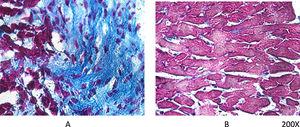 Masson's trichrome in rat myocardial tissue. After 60 days, myocardial damage due to obstructive nephropathy is clearly shown in (A), while in the same period but with daily treatment with paricalcitol, at a rate of 30 ng/kg/day IP, the fibrotic process was prevented (B).
