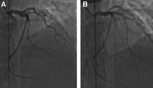 Pre (A) and post stent (B) placement on LAD during left heart catheterization.