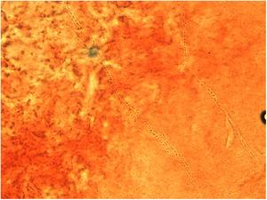 Skin scraping direct microscopic examination showing hyphae and thick-walled arthroconidia in formation (KOH mount, 60×).