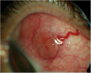 Slit-lamp photograph. An abscess and subjacent scleritis in superotemporal quadrant in the left eye with a dilated vessel are observed.