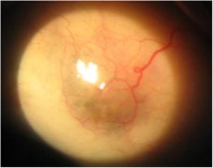 Slit-lamp photograph. Scleral thinning as a result of the infectous previous-process. A bluish patch and decreased thickness vessel is identified.