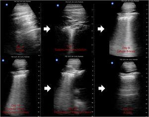 Changes in ultrasound findings from onset of symptoms to complete resolution on ultrasound in patient 1.