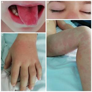Cutaneous-mucosal manifestations: A) strawberry tongue; B) bilateral eyelid oedema; C) erythema and oedema on the back of the hand and D) polymorphous rash on the left leg.