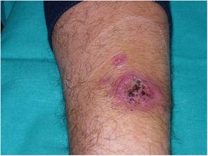 Purplish erythematous plaque with erosive and crusty surface on the forearm.