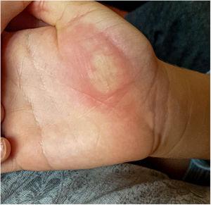 Image of the lesion which began as mild erythema.