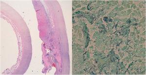 On the left, haematoxylin-eosin preparation of the aortic wall showing periadventitial necrosis and dense inflammatory infiltrate. On the right, Grocott's stain with the presence of filamentous pleomorphic bacilliform structures with one of the ends oval shaped.