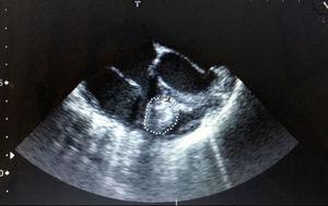 Ecocardiografía transtorácica de la paciente, en la que se visualiza el struma cordis a nivel del ventrículo derecho.