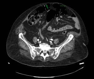 Imagen correspondiente a corte axial de la TC de abdomen realizada a la paciente donde se objetivan burbujas en la pared abdominal anterior, la cual tiene puntos de espesor de 3,8mm.