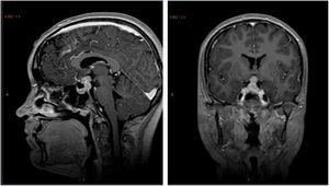 Resonancia magnética nuclear de una niña de 15 años que muestra un tumor supra- e intraselar; 3 años antes se había diagnosticado de diabetes insípida central aislada y ensanchamiento del tallo hipofisario. La biopsia demostró que era un tumor germinal no secretante.
