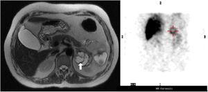 On the left: MRI, on T2, shows a 5.2cm partially cystic mass (arrow) with a hyperintense solid component on T2. On the right: 123I-metaiodobenzylguanidine (MIBG) scan reveals high uptake of the lesion, that is at the topographical location of the left adrenal gland.
