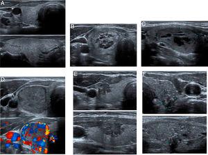 A correlation study between histological results and thyroid ultrasound