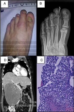 (A) Tumefacción en el segundo dedo del pie izquierdo. (B) Lesión ósea lítica en la falange proximal del segundo dedo del pie. (C) Infiltración ósea por células tumorales, tinción hematoxilina-eosina (×100). (D) Tomografía axial computarizada que muestra gran masa suprarrenal derecha que produce desplazamiento de estructuras adyacentes.