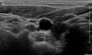 Échographie de la glande thyroïde montrant le lobe droit avec une hypoéchogénicité globale et l'aiguille 21G utilisée pour l'infiltration intraglandulaire de triamcinolone.