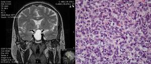 “Atypical” pituitary adenoma or well differentiated pituitary carcinoma in situ?