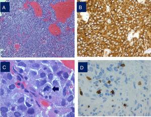 Histopathological study of an aggressive prolactinoma showing densely granulated lactotroph adenoma (A) with immunostaining positive for prolactin (B), with histological signs of aggressiveness [cellular pleomorphism and nuclear atypia, 2 mitotic figures for 10 high power fields (C, arrow), bone infiltration and Ki67 10% (D)].