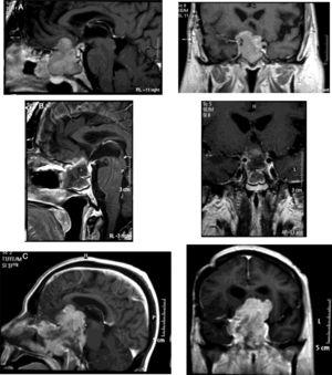 Sagittal and coronal pituitary T1-weighted MRI images of an aggressive type 2 silent corticotroph adenoma (sparsely granulated tumor) at different times of the disease. A. Before second surgery. B. After second surgery. C. Four months after second surgery.