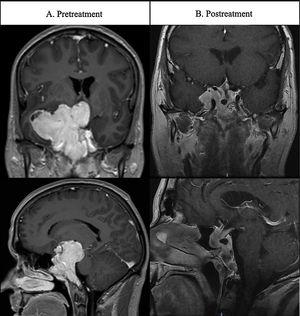 Patient 1's MRI images at presentation and after medical treatment.