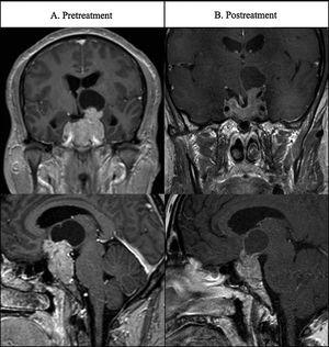Patient 3's MRI images at presentation and after medical treatment.