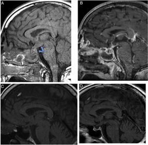 Pituitary MRI images. A: Sagittal T1 without contrast revealing hypothalamic-pituitary occupation with infundibular (pituitary stalk) thickening, which with the introduction of contrast (B) reveals peripheral enhancement and cystic content. C: Follow-up MRI one month after diagnosis: disappearance of the hypothalamic abscess. Persistence of an infiltrative lesion in the pituitary gland and in the pituitary stalk. D: Follow-up MRI at 6 months. Resolution of the hypothalamic-pituitary abscess.