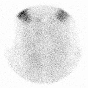 99mTc-pertechnetate scintigraphy. Absent 99mTc-pertechnetate uptake during thyroid scintigraphy performed in day+12 after onset of thyroiditis symptoms.