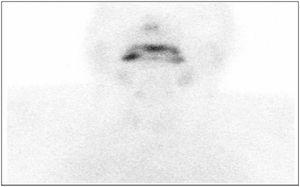 Increased vascular fundus uptake and near-absence of thyroid gland activity are observed. Scintigraphy consistent with acute thyroiditis.